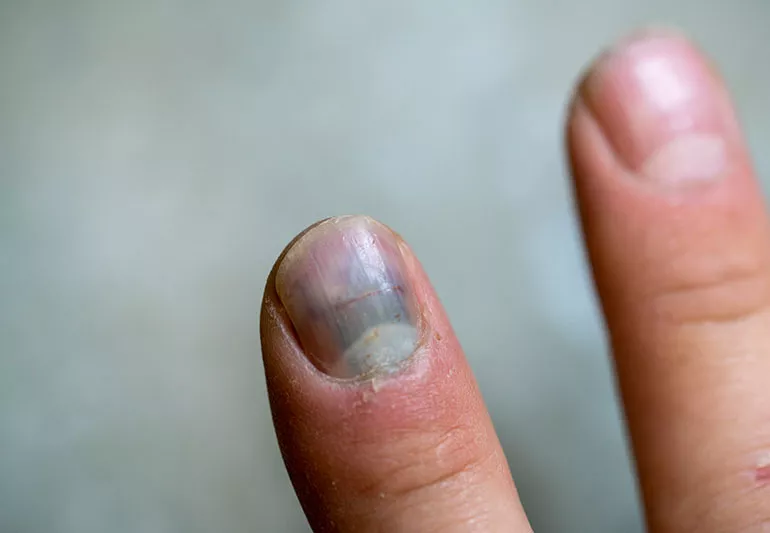 nail condition